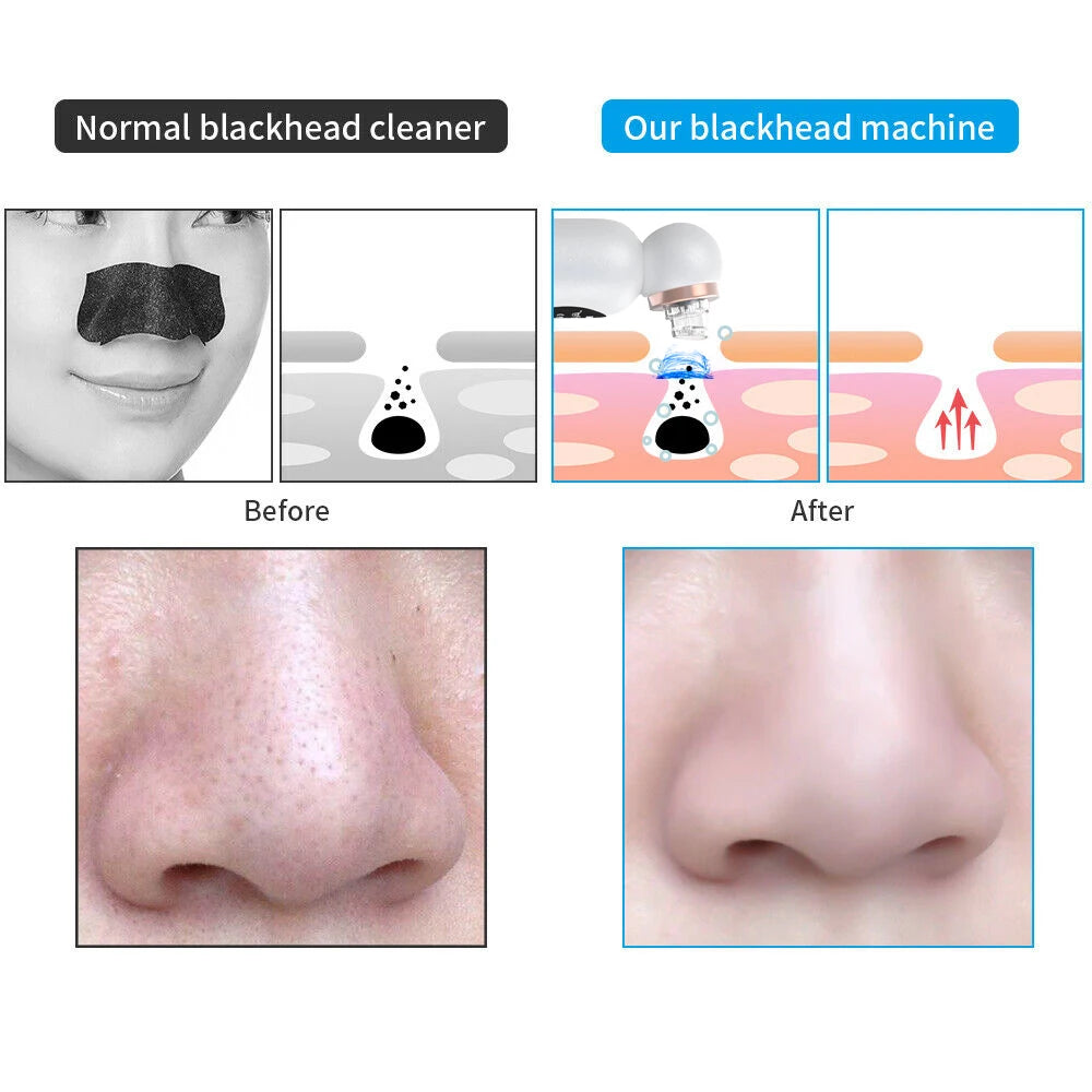 Blackhead Remover Vacuum Cleaner