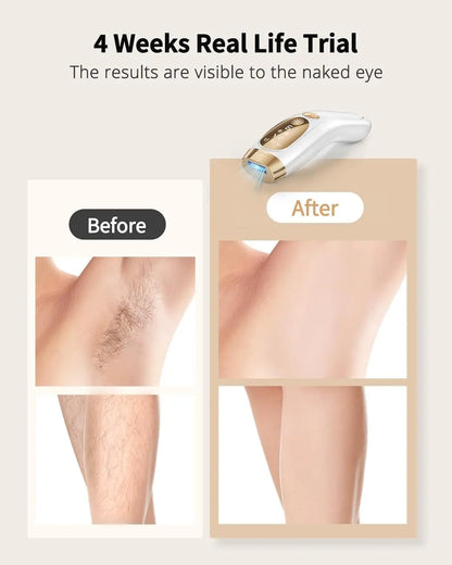 IPL Hair Removal Device